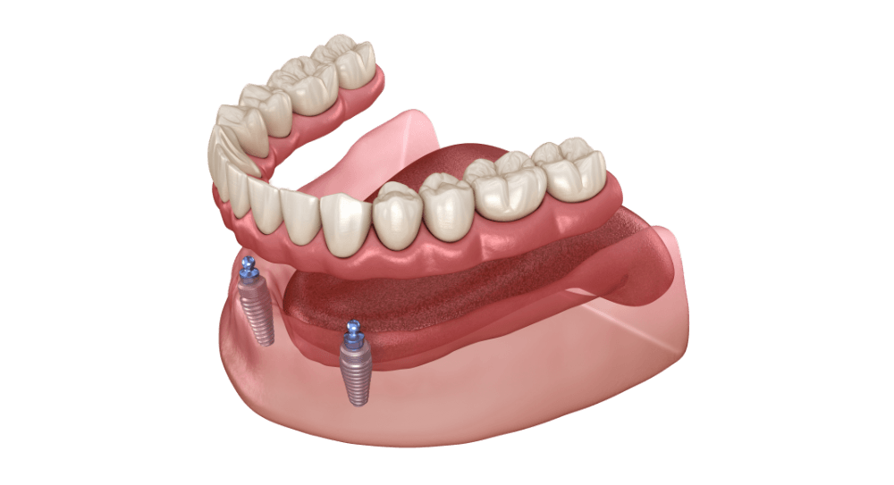 The overdenture is to be seated on two implants - ball attachments.