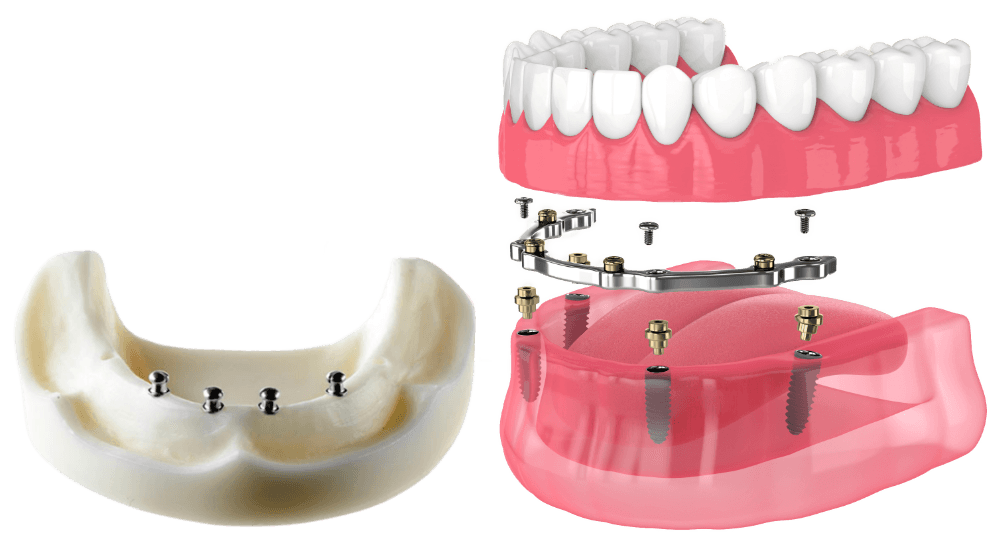 Dental implant supported-denture ball attachments are on the left, and the bar attachment is on the right.