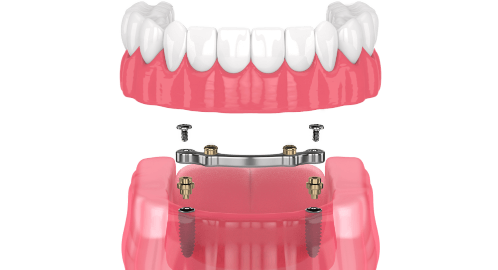 Implant-Supported Dentures