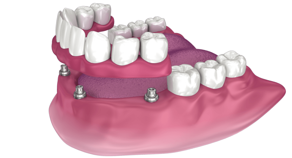 Overdenture to be seated on 4 implants - ball attachments.