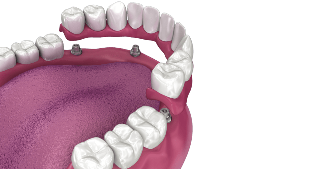 Overdenture to be seated on 4 implants - ball attachments.